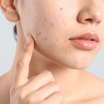 Anti Acne Range